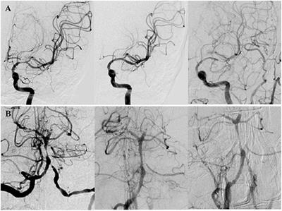 Long-Term Outcome of Enterprise Stenting for Symptomatic ICAS in a High-Volume Stroke Center